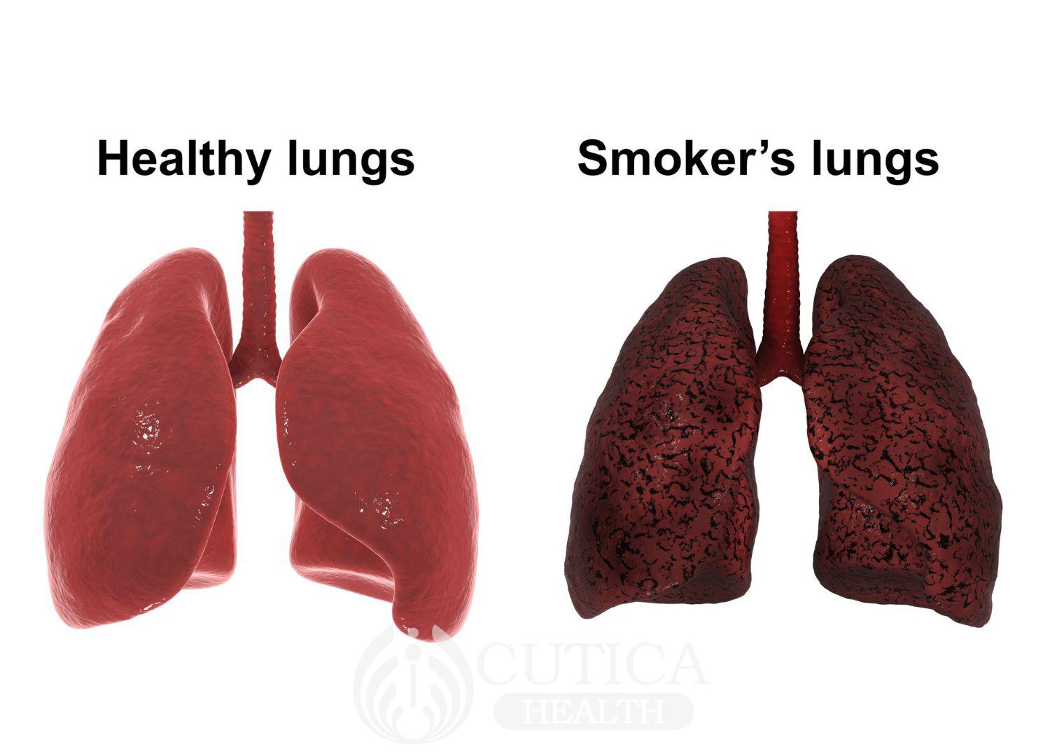 Chronic Obstructive Pulmonary Disease 24-11-2022 (3)